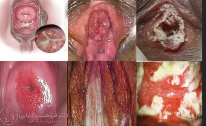 عکس انواع عفونت واژن